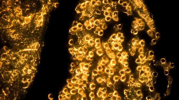 Найдено решение одной из ключевых проблем в лечении рака