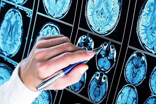 Бесплатная нейросеть нашла аномалии мозга у детей с эпилепсией