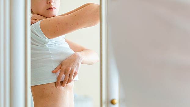 Названа диета, которая облегчает симптомы псориаза