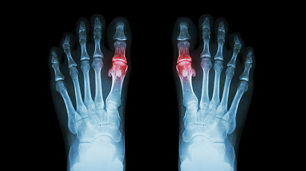 Стало известно, откуда берется подагра