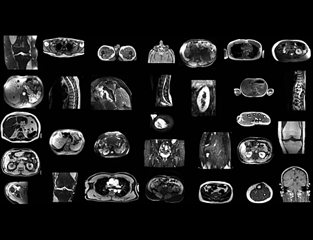 Новый ИИ научили анализировать МРТ-снимки