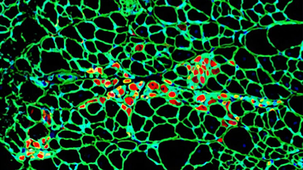Ученые добились прорыва в борьбе с тяжелой и неизлечимой мышечной дистрофией