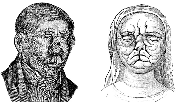 Названа одна из первых болезней, поразивших человечество