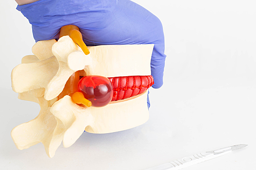 Обнаружен белок, отвечающий за появление грыжи в позвоночнике