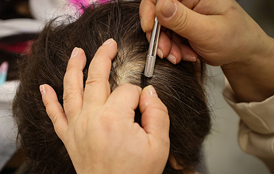 Ученые открыли новый метод лечения через волосяные фолликулы