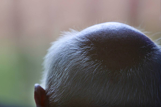 Найден способ борьбы с облысением