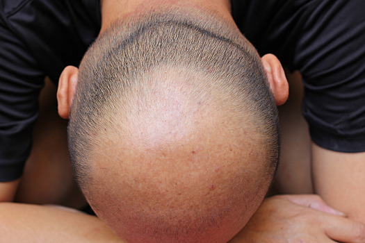 Раскрыт ключевой механизм облысения