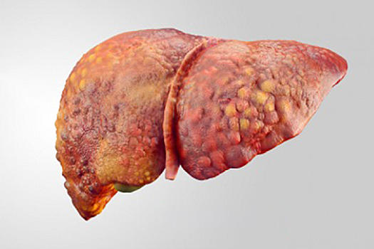 Обнаружен ген, защищающий печень от ожирения