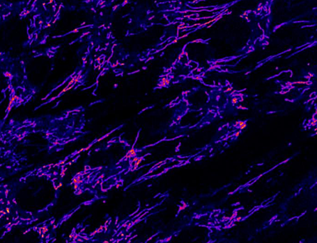 Выяснено, что нарушает метаболизм жиров в организме