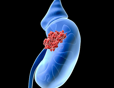 Выяснено, насколько распространен ген, вызывающий рак почки