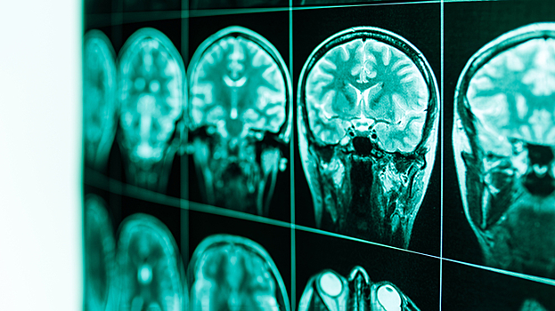 Стало известно, какие участки мозга повреждает алкоголь