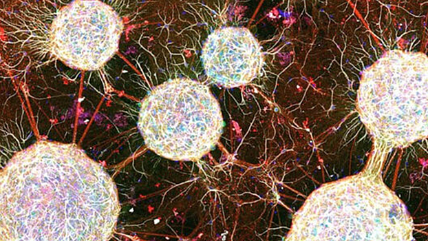 Раскрыта связь между шизофренией и ускоренным старением мозга