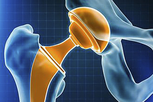 Ученые нашли неожиданный плюс в повреждениях костных протезов