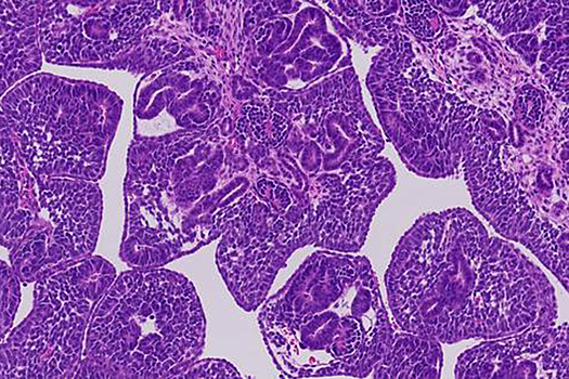 Обнаружены миллионы скрытых изменений ДНК в детских раковых опухолях