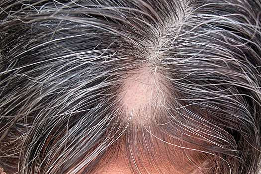 Ученые открыли простой способ избежать выпадения волос