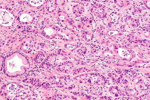 Раскрыт секрет распространения агрессивного рака поджелудочной