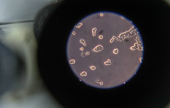 Найдена причина ускоренного роста агрессивного рака груди