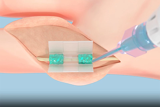 В MIT создали революционный клей на замену хирургическим швам