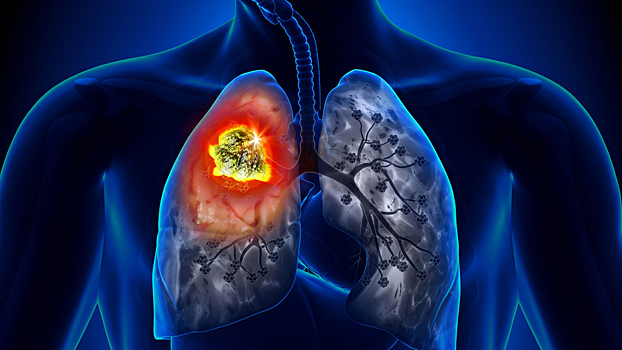 Стало известно, почему рак груди часто метастазирует в легкие