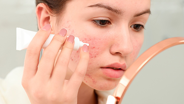 Лекарство от прыщей оказалось эффективным защитником от шизофрении