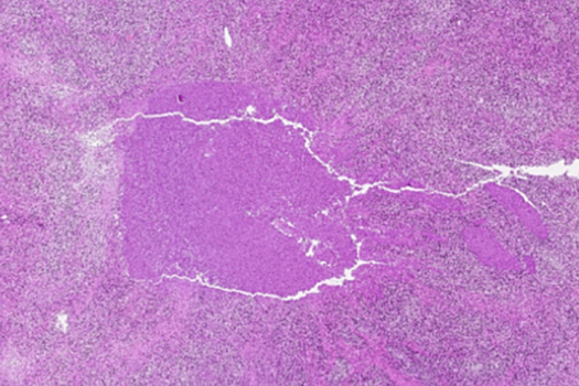 Злокачественную опухоль впервые смогли разрушить необычным способом