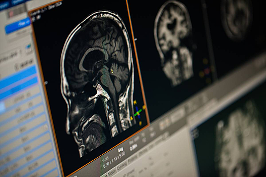 Ученые нашли причину ухудшения работы мозга у миллионов людей