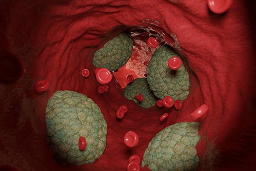 Как нехватка «топлива» для иммунных клеток повышает риск бляшек в сосудах