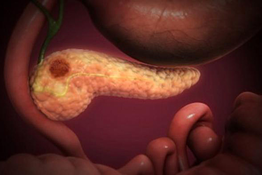 Выявлена неожиданная «помеха» в лечении рака поджелудочной