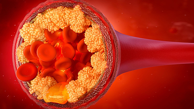 Впервые прошел испытания препарат, снижающий уровень жиров в крови