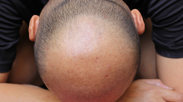 Создана шапка против выпадения волос