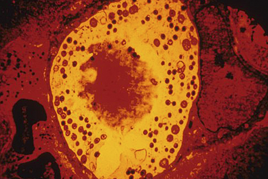 Стало известно, что может активировать болезнь Альцгеймера