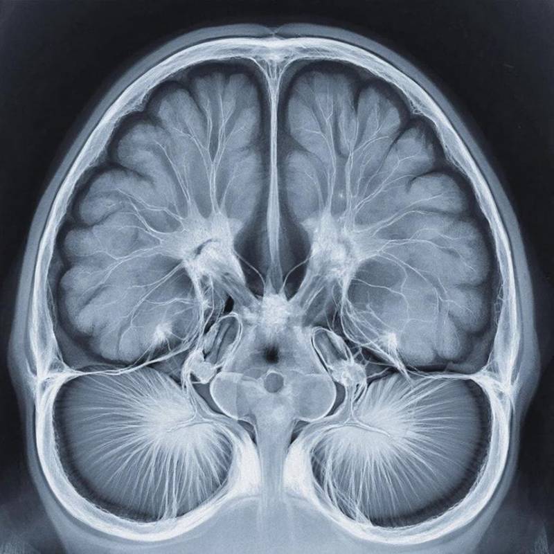 На Чукотке нейросети обучат расшифровывать КТ мозга
