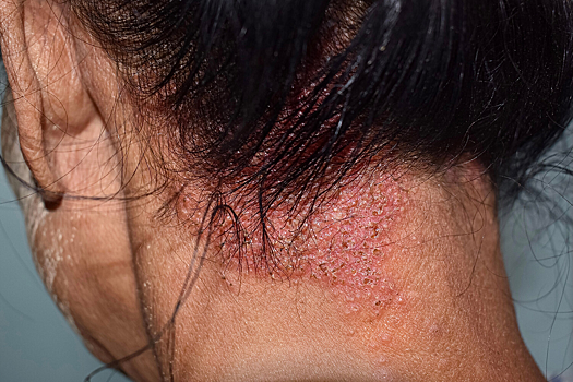 У каждого седьмого россиянина выявили ген риска стригущего лишая